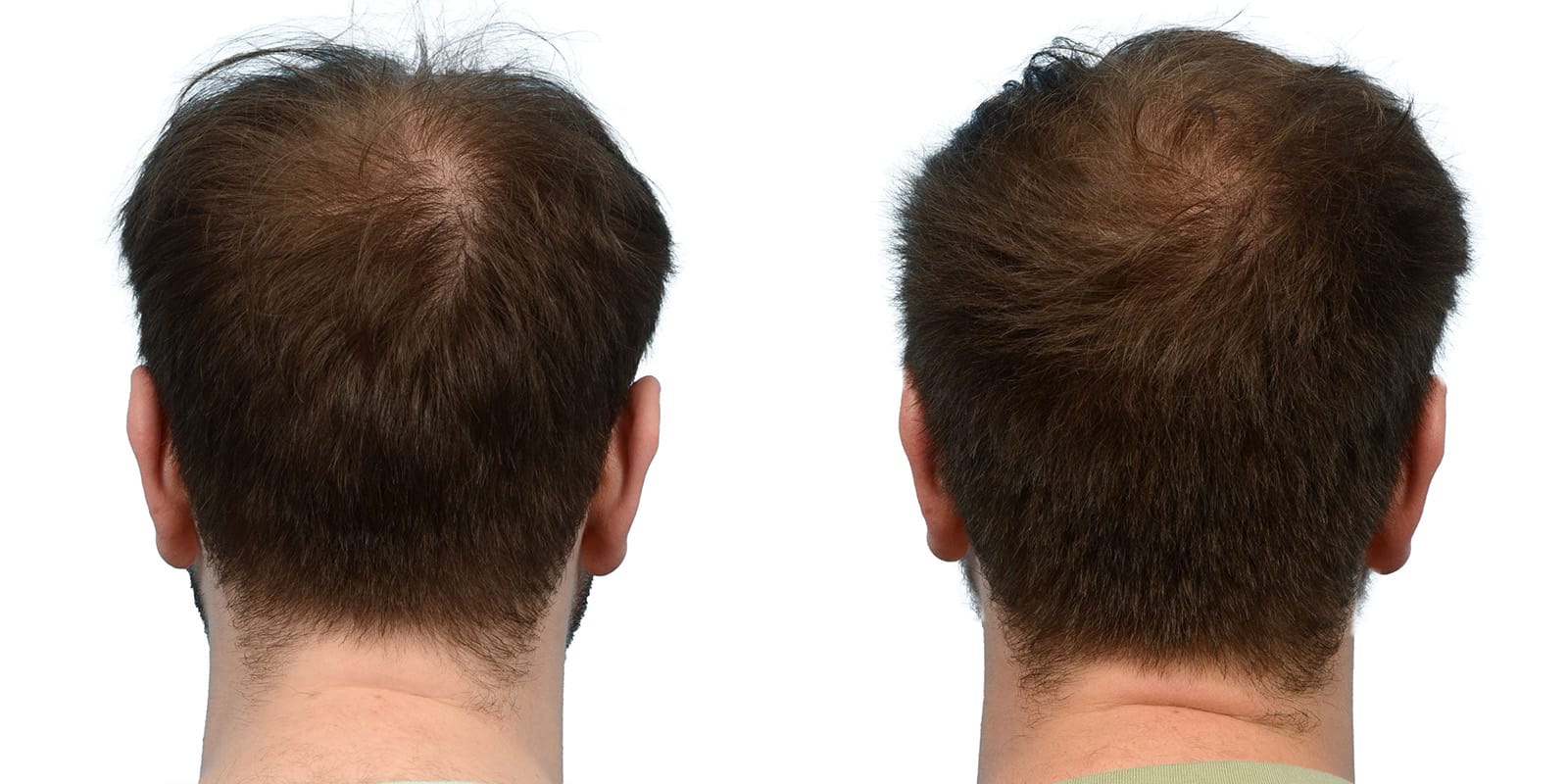 Platelet-Rich-Plasma Before & After Gallery - Patient 152583 - Image 2