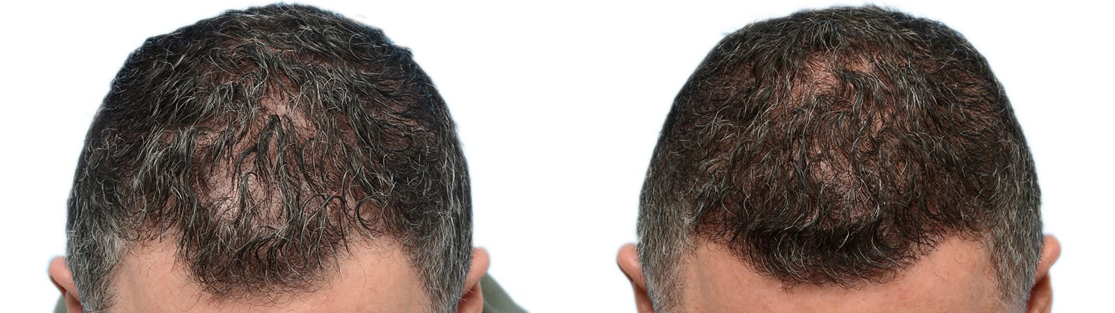 FUE Hair Transplant Before & After Gallery - Patient 398616 - Image 4