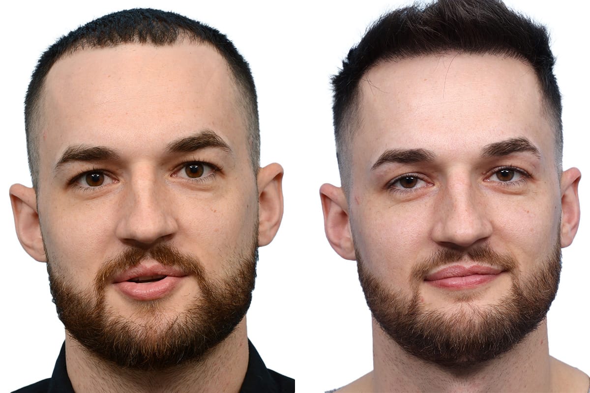 Hair Restoration  Before & After Gallery - Patient 127666 - Image 2