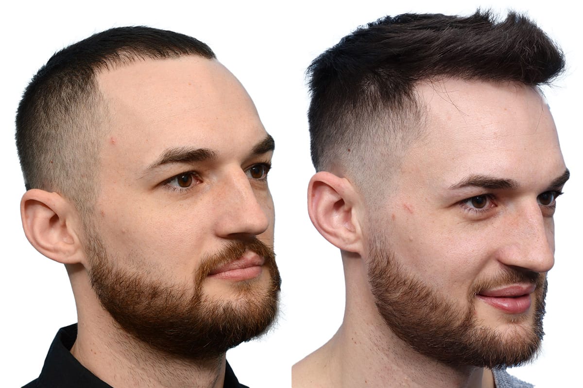 Hair Restoration  Before & After Gallery - Patient 127666 - Image 3
