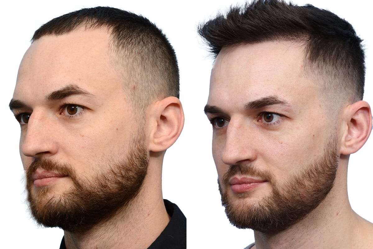 Hair Restoration  Before & After Gallery - Patient 127666 - Image 4