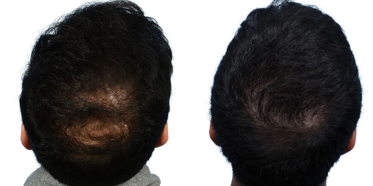 FUE Hair Transplant Before & After Gallery - Patient 750055 - Image 2