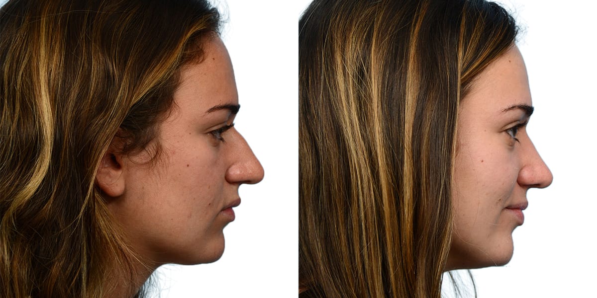 Rhinoplasty Before & After Gallery - Patient 134052 - Image 1
