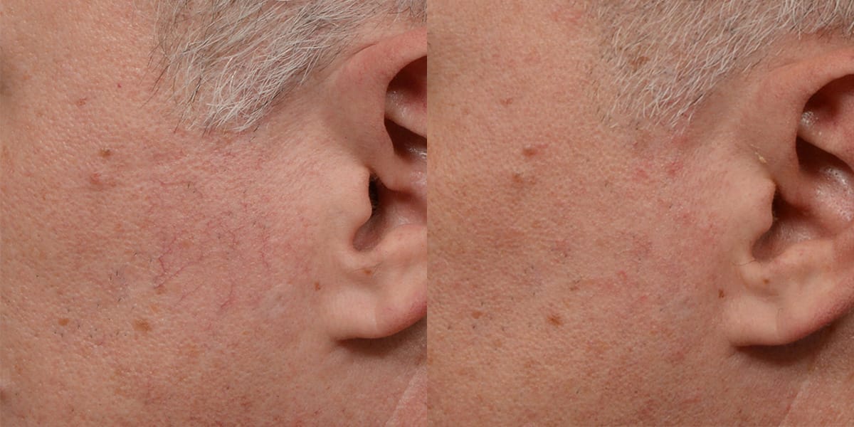 VBeam® Before & After Gallery - Patient 172339 - Image 2