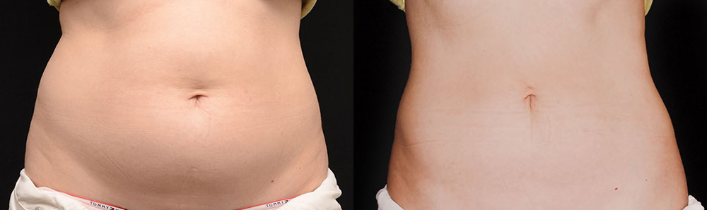 Before & After CoolSculpting
