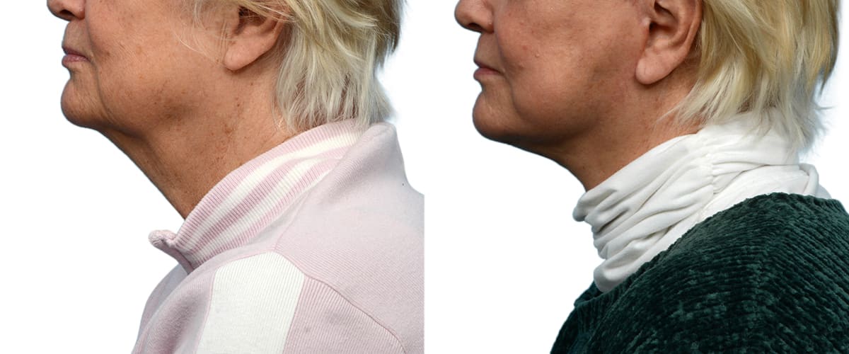 Facelift Before & After Gallery - Patient 258284 - Image 2
