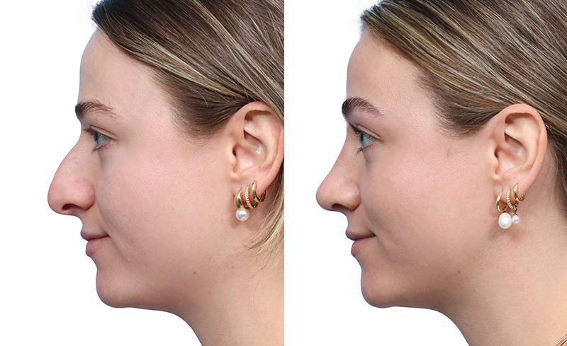 Rhinoplasty Before & After Gallery - Patient 222085 - Image 3