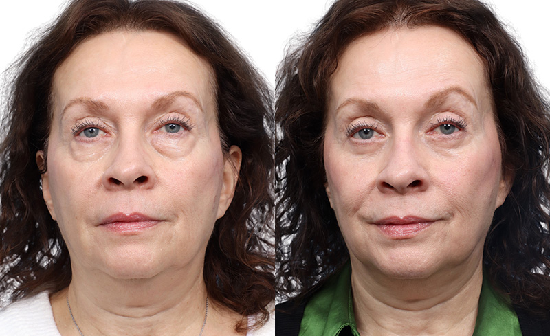 Blepharoplasty (Eyelid Surgery) Before & After Gallery - Patient 425125 - Image 1