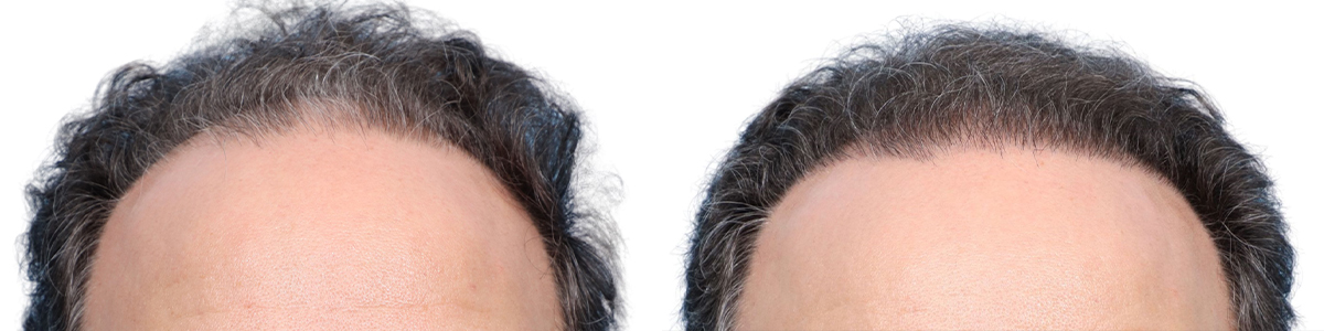 FUE Hair Transplant Before & After Gallery - Patient 173730 - Image 1