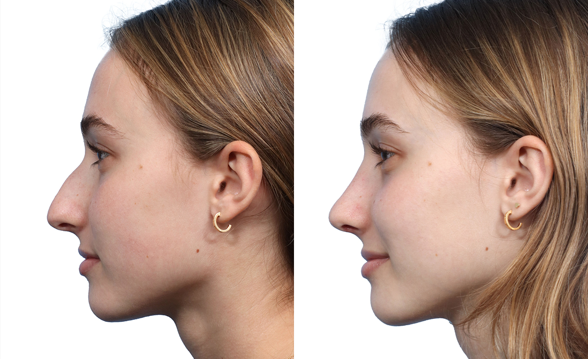 Rhinoplasty Before & After Gallery - Patient 327524 - Image 2