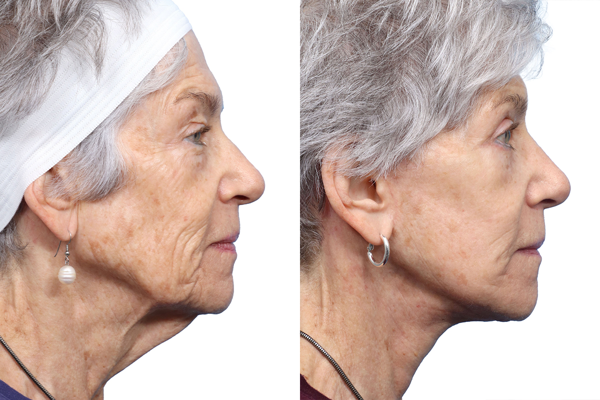 Blepharoplasty (Eyelid Surgery) Before & After Gallery - Patient 449834 - Image 3