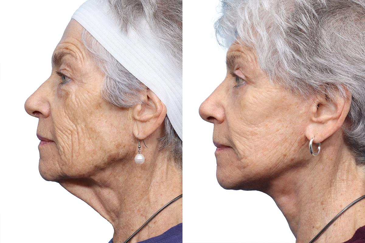 Blepharoplasty (Eyelid Surgery) Before & After Gallery - Patient 449834 - Image 2