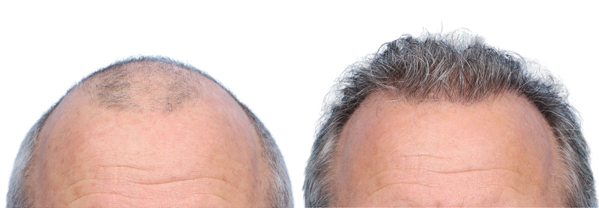 FUE Hair Transplant Before & After Gallery - Patient 242809 - Image 1