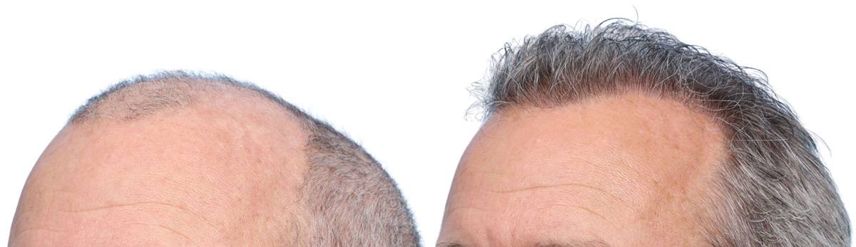 FUE Hair Transplant Before & After Gallery - Patient 242809 - Image 3