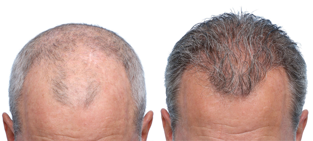 FUE Hair Transplant Before & After Gallery - Patient 242809 - Image 4