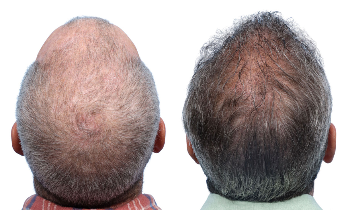 FUE Hair Transplant Before & After Gallery - Patient 242809 - Image 5