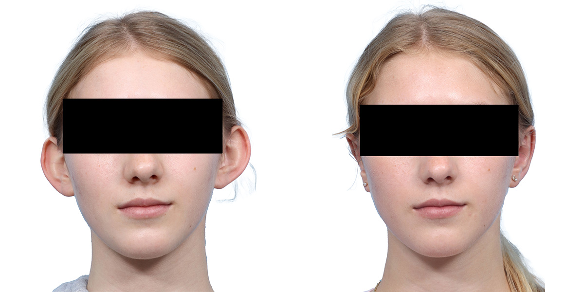 Otoplasty (Ear Surgery) Before & After Gallery - Patient 160305 - Image 1