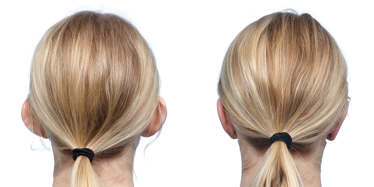 Otoplasty (Ear Surgery) Before & After Gallery - Patient 160305 - Image 2