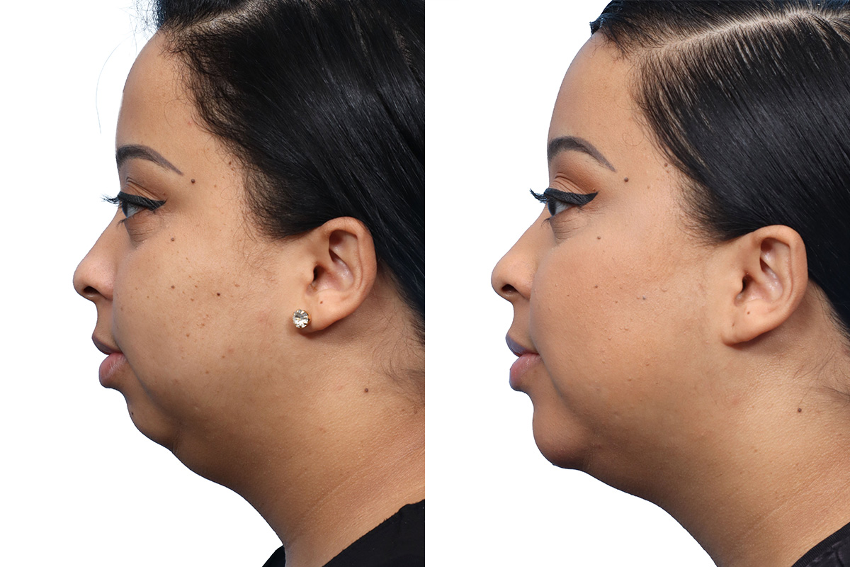 Chin Augmentation Before & After Gallery - Patient 359908 - Image 2