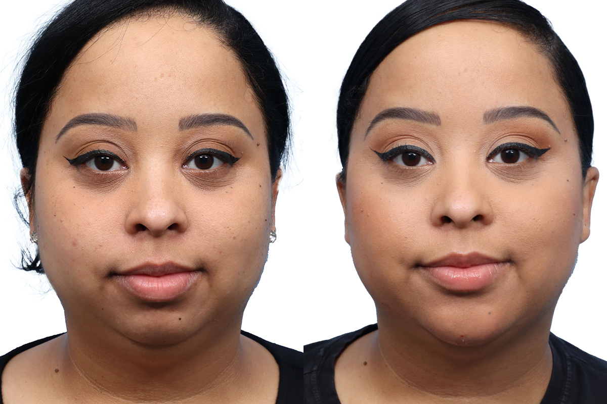 Chin Augmentation Before & After Gallery - Patient 359908 - Image 3