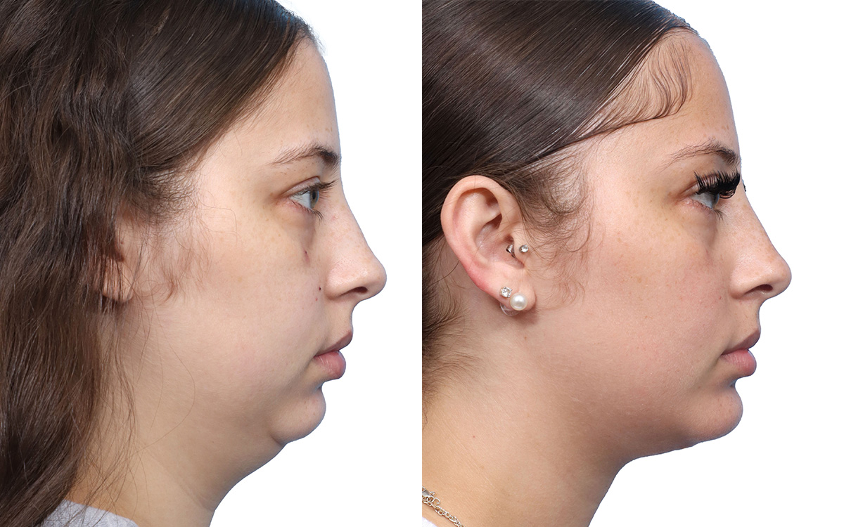 Submental Liposuction Before & After Gallery - Patient 287321 - Image 1
