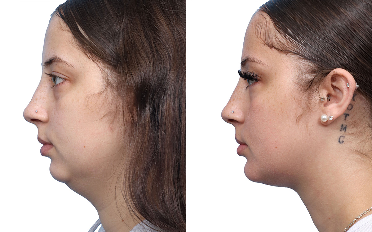 Submental Liposuction Before & After Gallery - Patient 287321 - Image 2