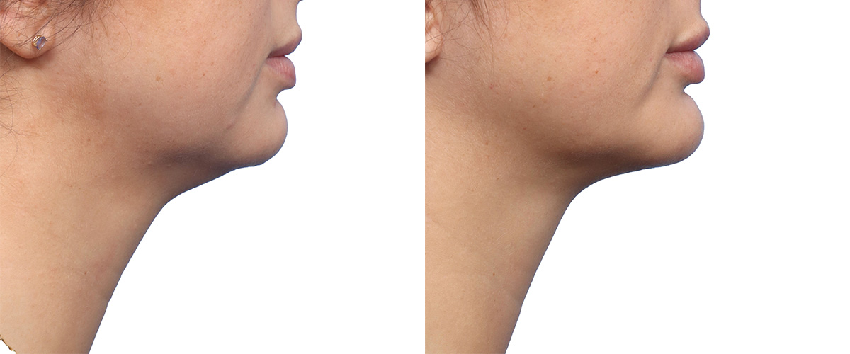 Submental Liposuction Before & After Gallery - Patient 184624 - Image 1