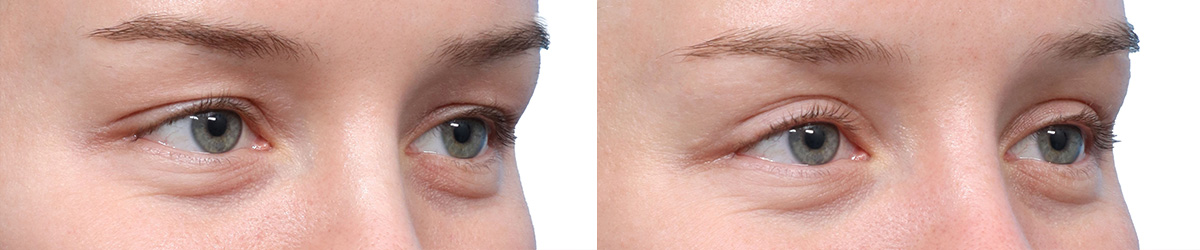 Blepharoplasty (Eyelid Surgery) Before & After Gallery - Patient 250042 - Image 2