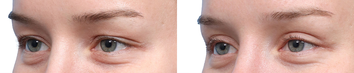 Blepharoplasty (Eyelid Surgery) Before & After Gallery - Patient 250042 - Image 3
