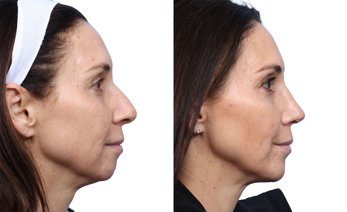 Rhinoplasty Before & After Gallery - Patient 245364 - Image 1