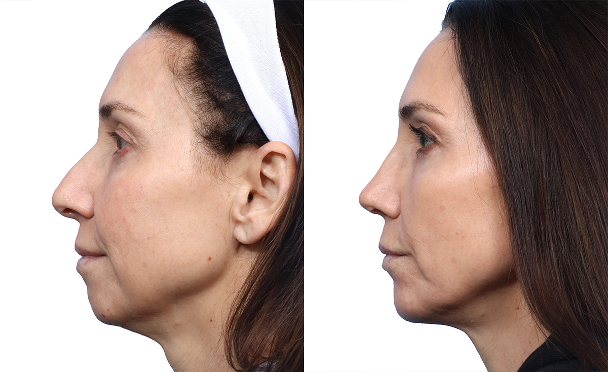 Rhinoplasty Before & After Gallery - Patient 245364 - Image 2