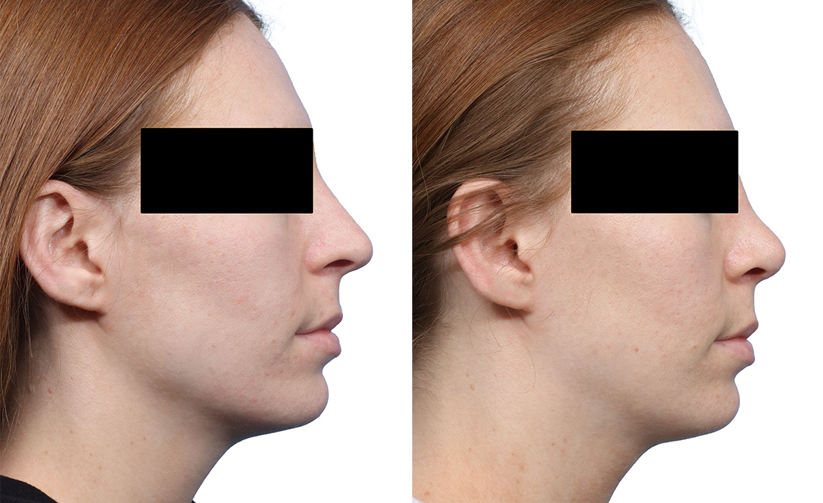 Rhinoplasty Before & After Gallery - Patient 246236 - Image 1