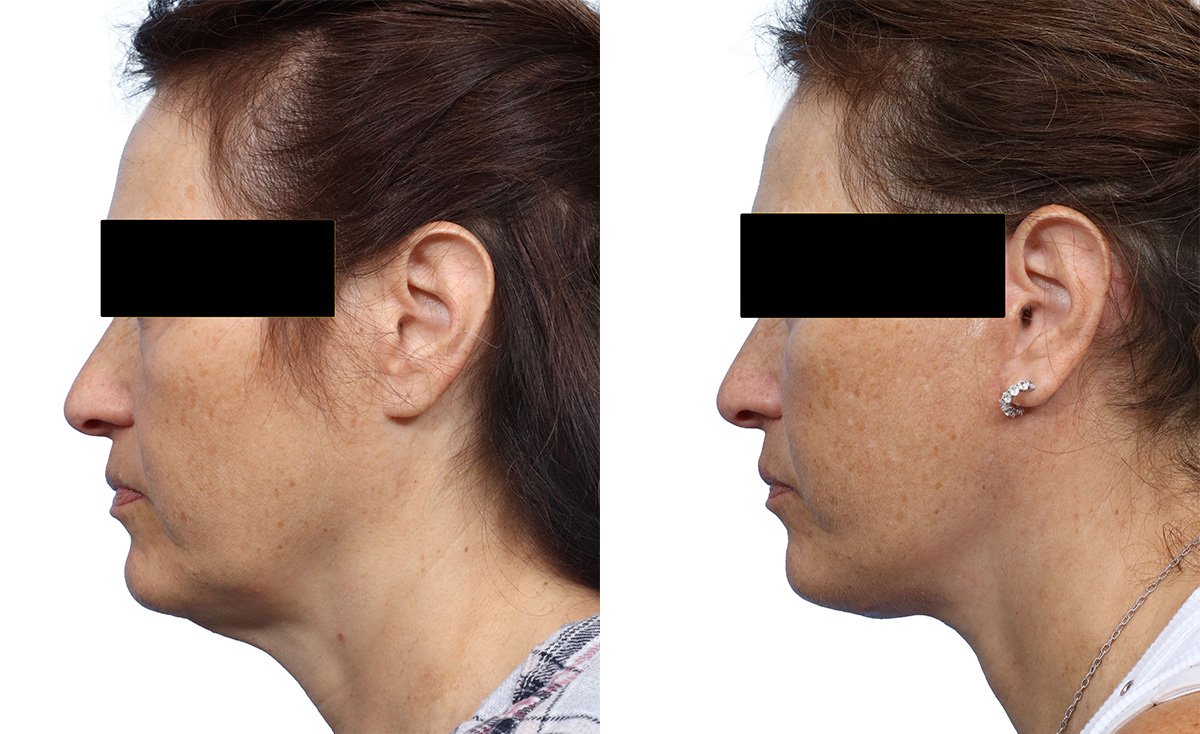 Deep Plane Facelift Before & After Gallery - Patient 700039 - Image 1