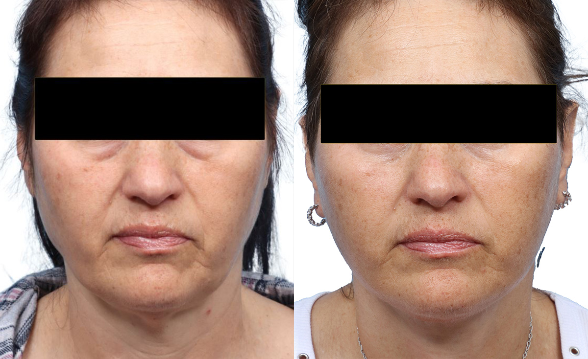 Blepharoplasty (Eyelid Surgery) Before & After Gallery - Patient 388953 - Image 1