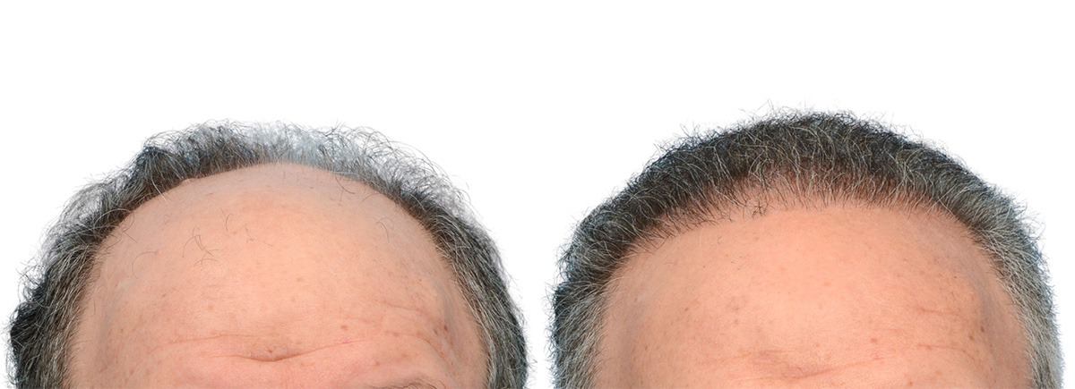 FUE Hair Transplant Before & After Gallery - Patient 718176 - Image 1