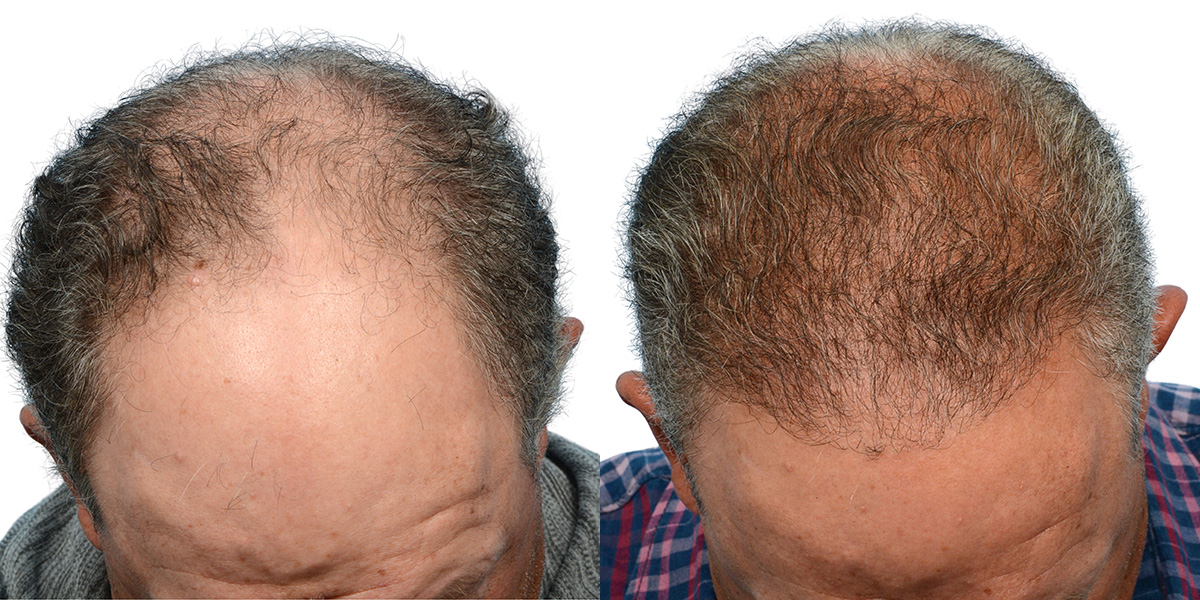FUE Hair Transplant Before & After Gallery - Patient 718176 - Image 4
