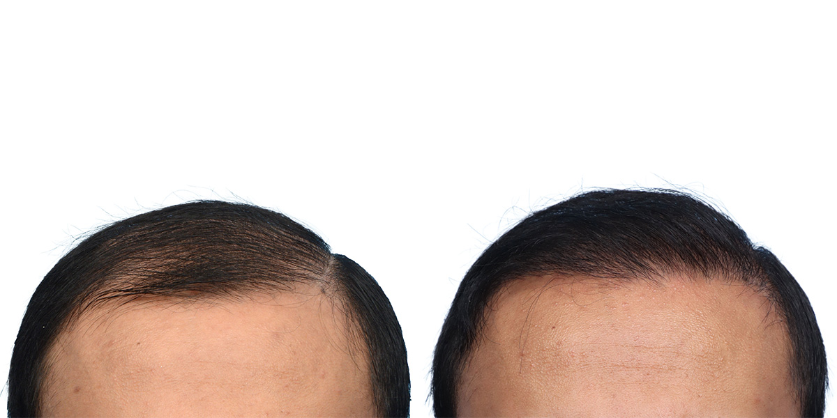 FUE Hair Transplant Before & After Gallery - Patient 153876 - Image 2