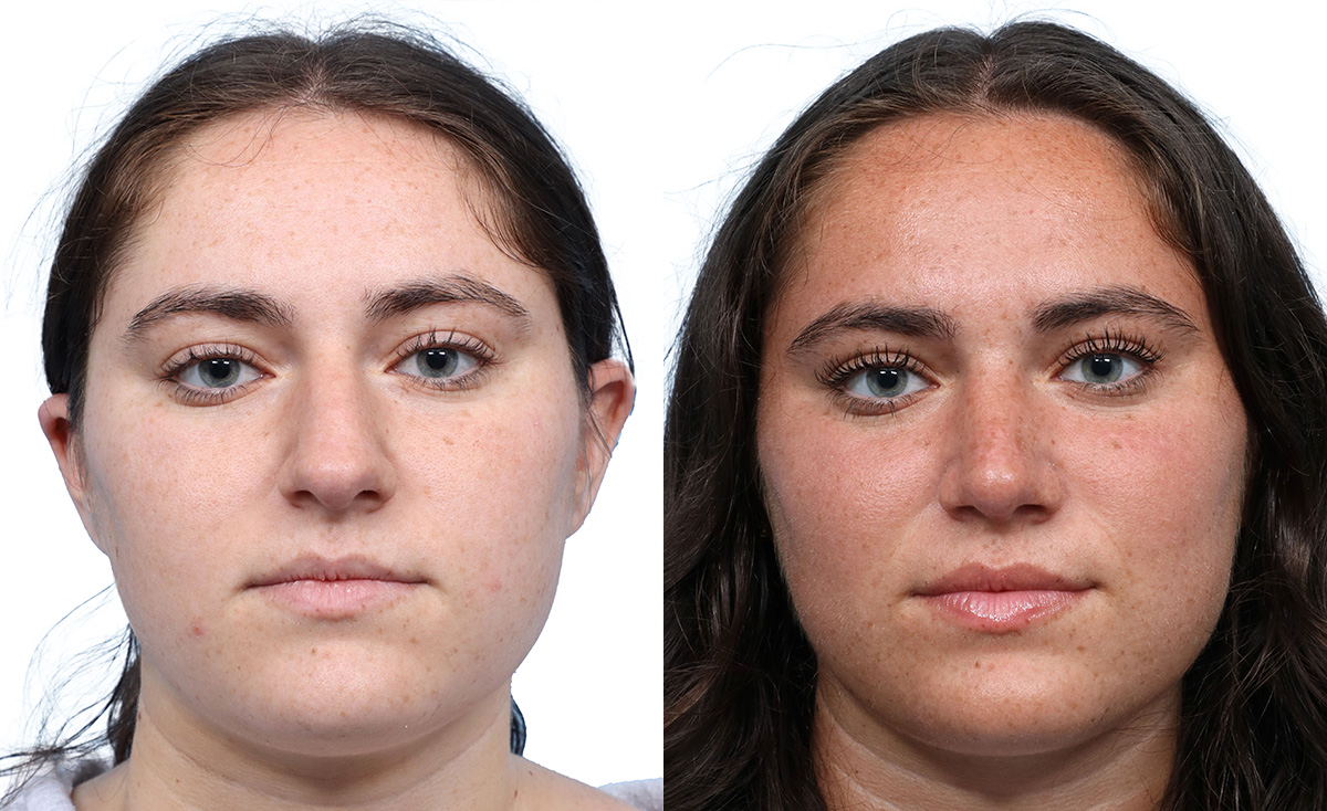 Rhinoplasty Before & After Gallery - Patient 324173 - Image 3