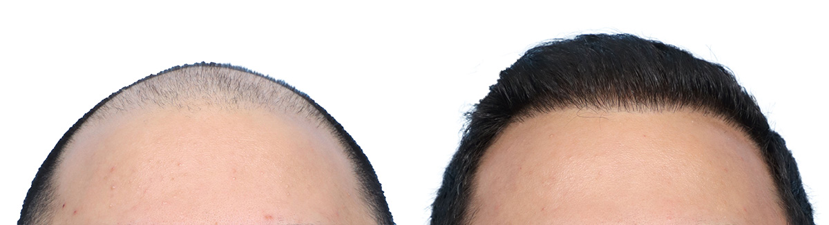 FUE Hair Transplant Before & After Gallery - Patient 130907 - Image 3