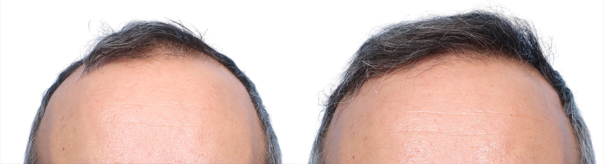 FUE Hair Transplant Before & After Gallery - Patient 428660 - Image 1