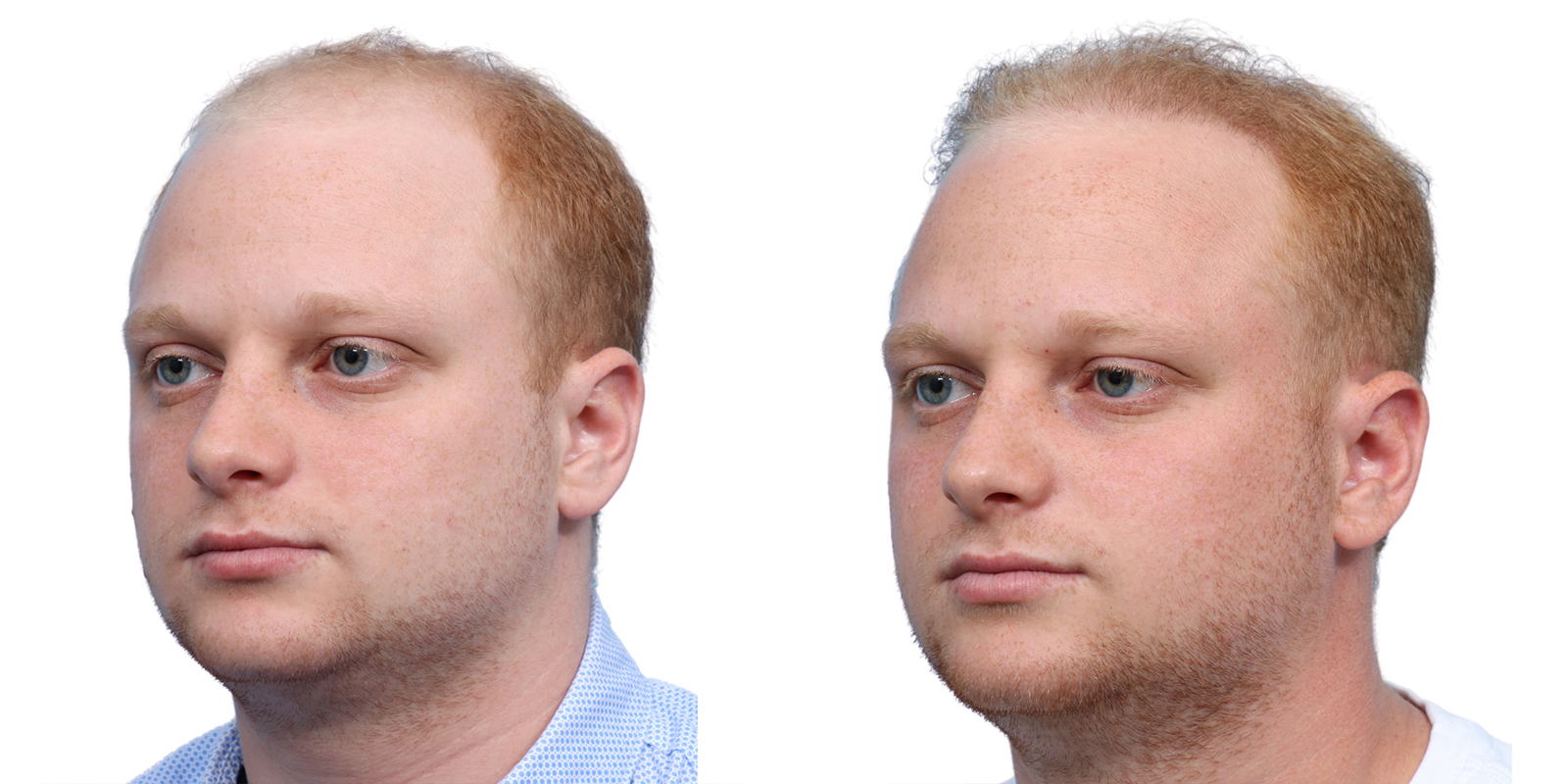 FUE Hair Transplant Before & After Gallery - Patient 243692 - Image 3