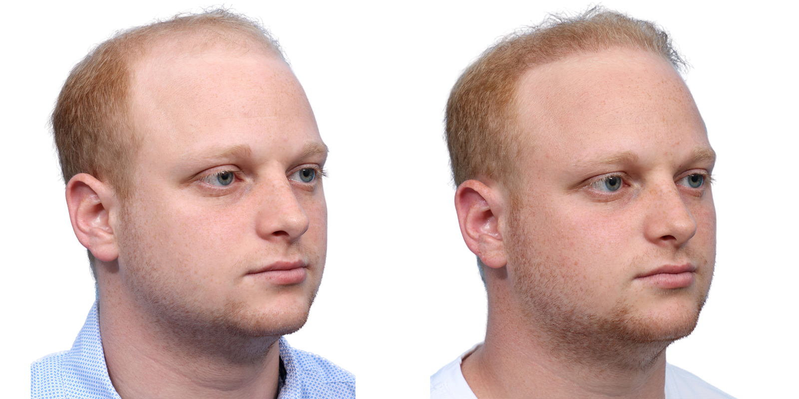 FUE Hair Transplant Before & After Gallery - Patient 243692 - Image 2