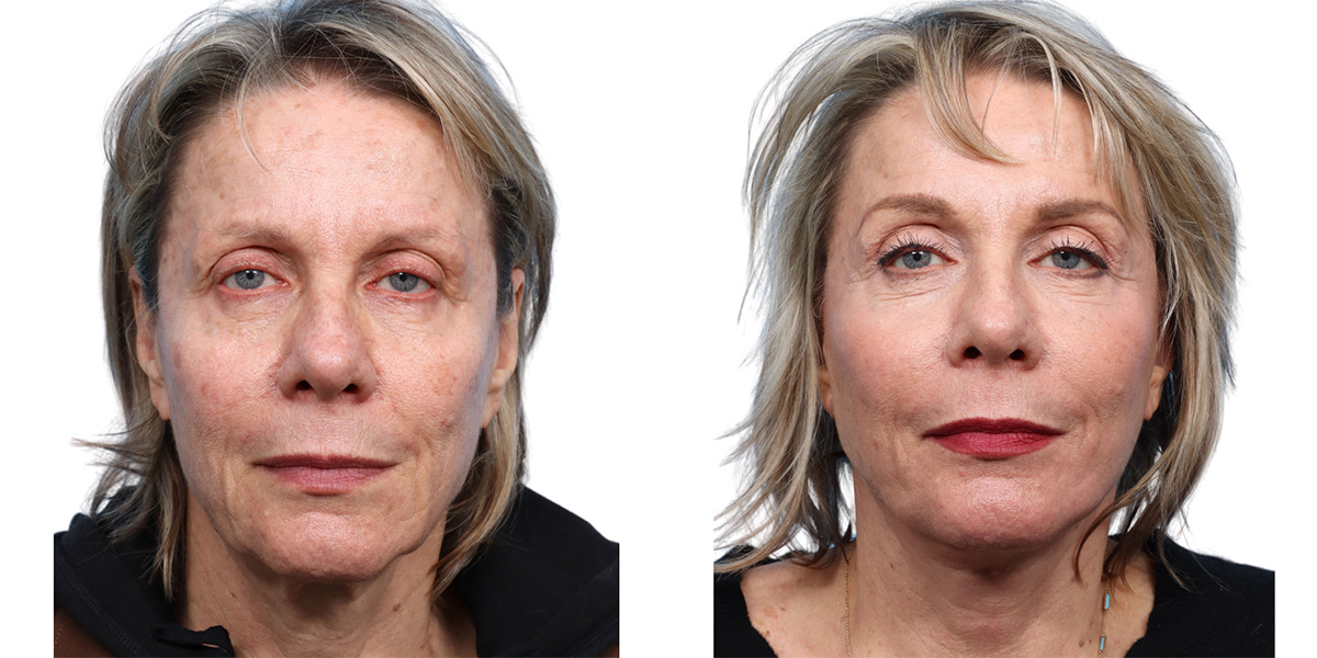 Deep Plane Facelift Before & After Gallery - Patient 103752 - Image 3