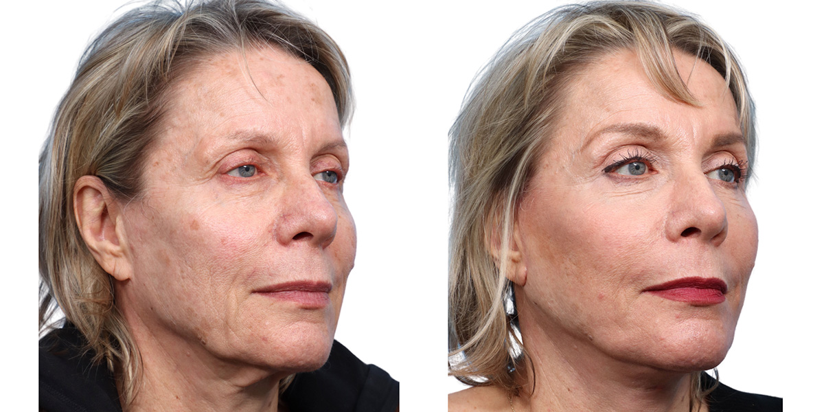 Deep Plane Facelift Before & After Gallery - Patient 103752 - Image 2