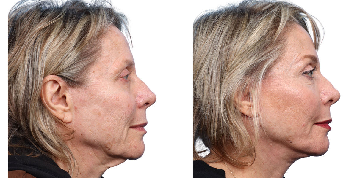 Facial Fat Transfer Before & After Gallery - Patient 716682 - Image 1