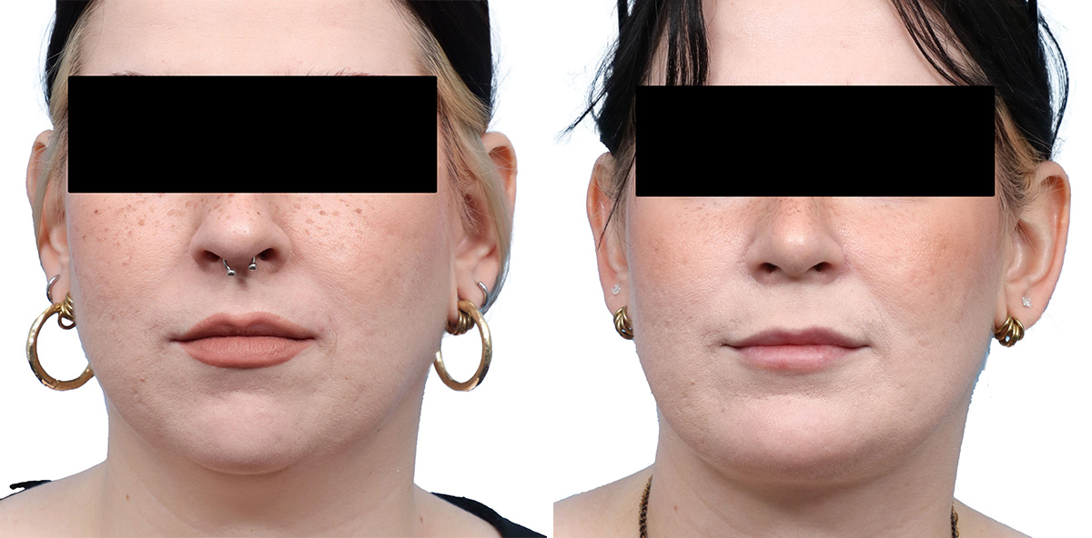 Submental Liposuction Before & After Gallery - Patient 210177 - Image 3