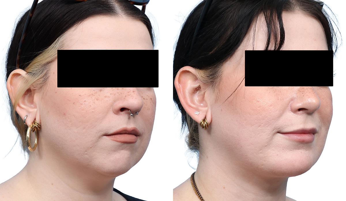 Submental Liposuction Before & After Gallery - Patient 210177 - Image 2