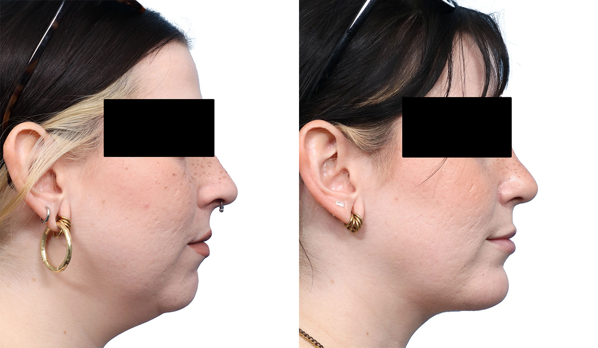 Submental Liposuction Before & After Gallery - Patient 210177 - Image 1