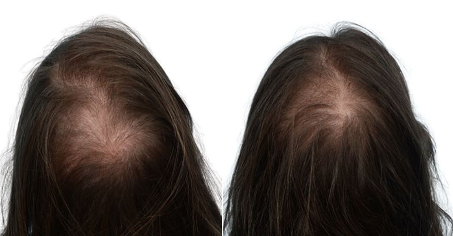 Platelet-Rich-Plasma Before & After Gallery - Patient 150780 - Image 1