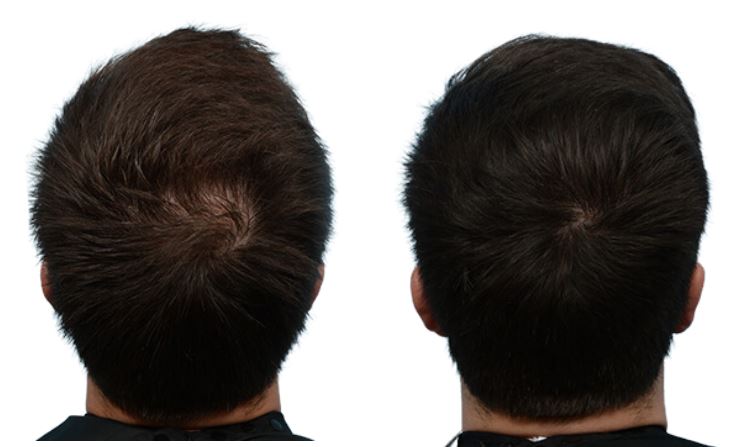 Platelet-Rich-Plasma Before & After Gallery - Patient 360025 - Image 1